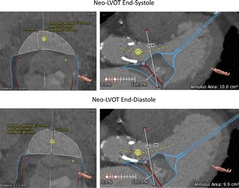 Ct In Transcatheter Delivered Treatment Of Valvular Heart Disease