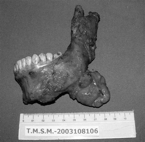Low Grade Central Osteosarcoma Of The Mandible A Case Study Report