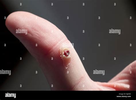 Wart Close Up On Thumb Skin After Freezing Medication Stock Photo Alamy