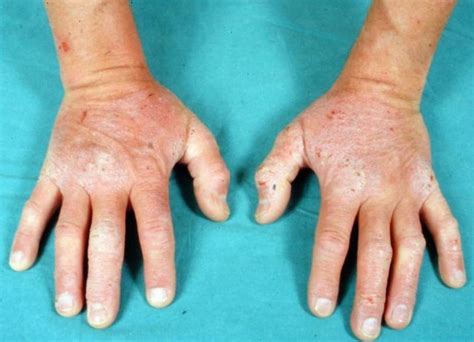 Se Duplican Casos De Dermatitis De Contacto Debido A Lavado Frecuente