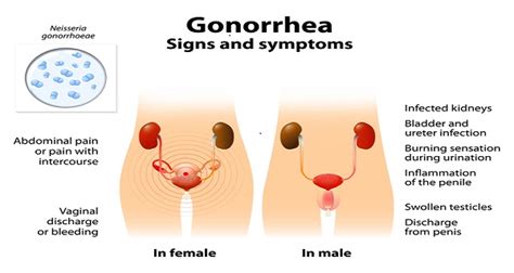 How Serious Is Gonorrhea Healthyville