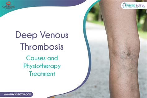 Deep Venous Thrombosis Dvt Causes And Physio Treatments