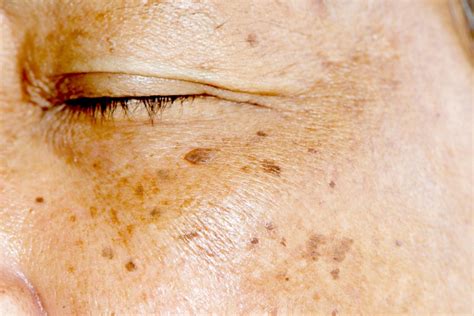 Causes Of Hyperpigmentation How To Fade Age Spots