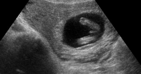 Early Gender Boys 13 Weeks 3d 4d Hd Ultrasound Virginia