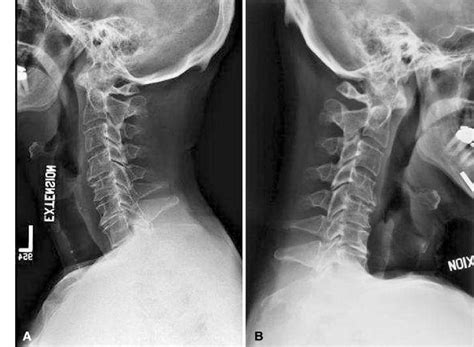 A B Lateral A Flexion And B Extension Views Of The Cervical Spine