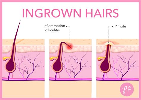 Ingrown Hairs Preventing Future Problems