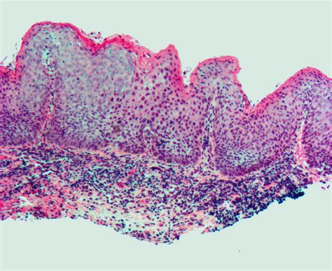 Vulvar Intraepithelial Neoplasia VIN Pictures Treatment Symptoms