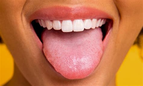 White Painful Bump On Tongue Canadanasad