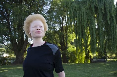 Albinizm co to jest Jakie są przyczyny albinizmu Jak wygląda