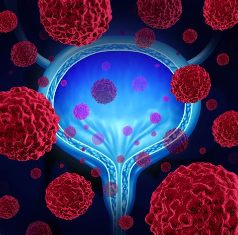 Blue Light Cystoscopy Increases Bladder Cancer Detection Rate Renal