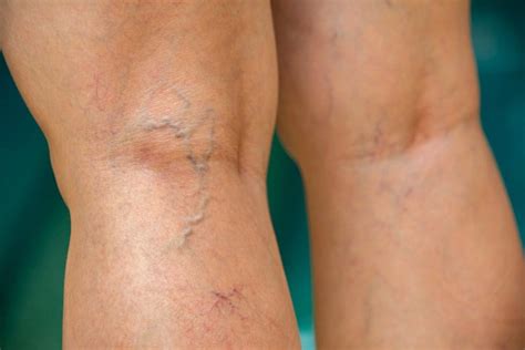 Blue Veins What Causes Veins To Be More Visible And How To Treat Them
