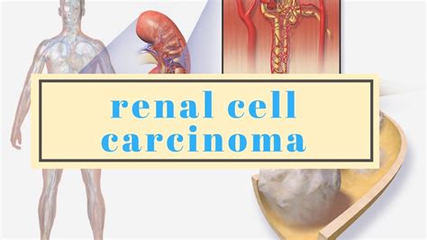 Renal Cell Carcinoma Prognosis Life Expectancy And Survival Rates Youtube