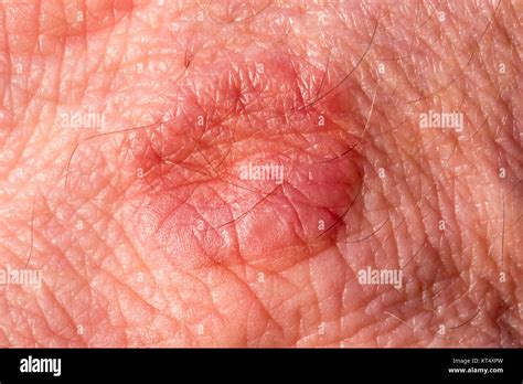 Peau Avec éruption Cutanéeeczéma Photo Stock Alamy