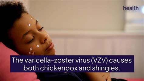 Chickenpox Vs Shingles Causes Symptoms And Treatments
