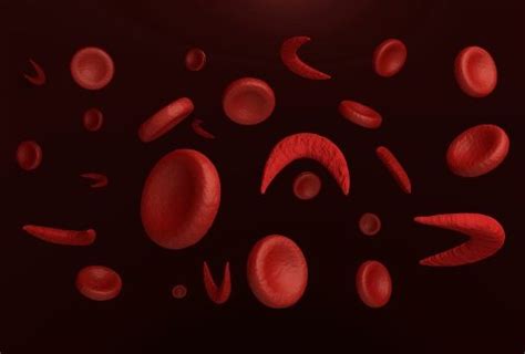 Sickle Cell Disease In Pregnant Women Increases Risk Of Stillbirth And