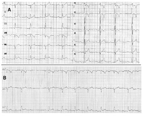 A Baseline Ecg Of The Patient Showing Sinus Rhythm With Fi Rst Degree