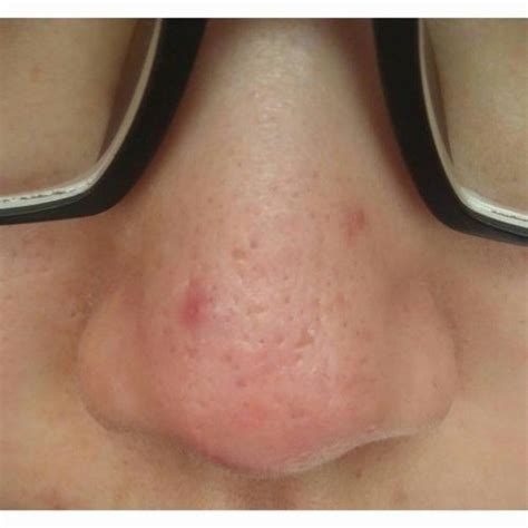 What Types Of Scars Are On My Nose With Pics Help Plz Scar Treatments Forum