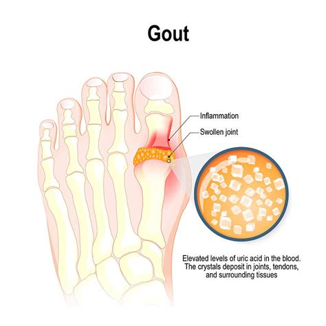 Gout Treatment In Kerala Gout Arthritis Care In India