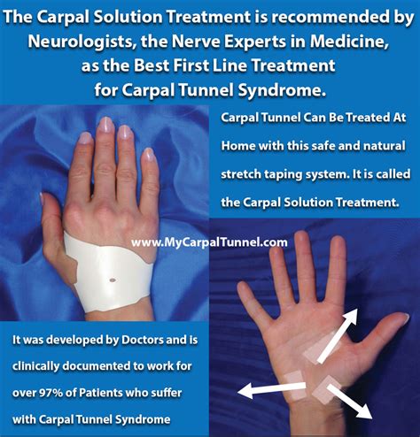 How To Treat Carpal Tunnel At Home The Carpal Solution