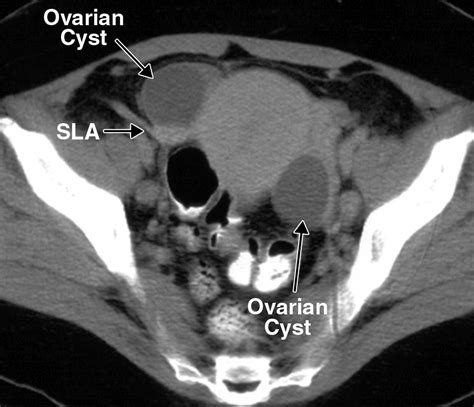 Recognition Of The Ovaries And Ovarian Origin Of Pelvic Masses With CT