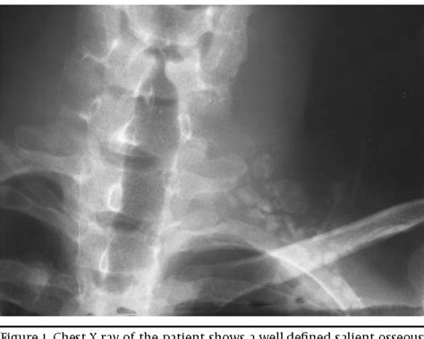 Figure 1 From A Rare Case Of Rib Osteoblastoma Imaging Features And