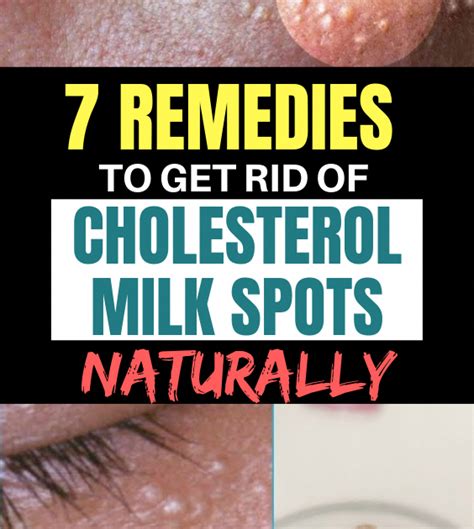 7 Remedies To Get Rid Of Cholesterol Milk Spots Naturally Health And Tips