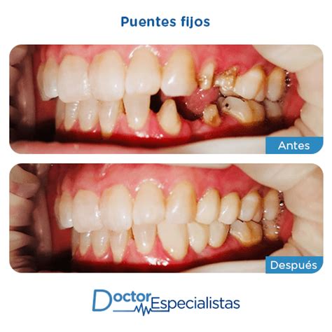 Mejores Clinicas Dentales Para Puentes Fijos Doctor Especialistas
