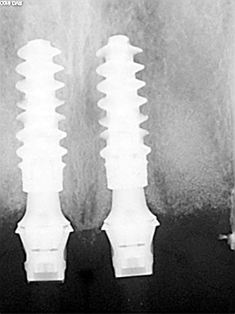 Implant Abutment Selection In Fixed Prosthodontics ITI Blog