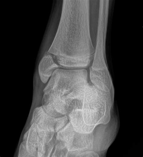 Orthodx Ankle Fracture In Teen Clinical Advisor