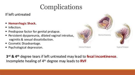 Rectovaginal Fistula And Perineal Tear
