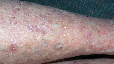 White Spots On Legs Dry Spots Itchy Blood Circulation