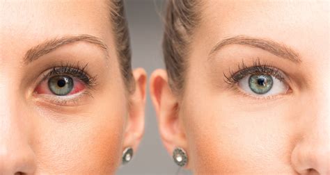 Glaucoma Drops And Eye Redness Laura Crawley London Eye Surgeon