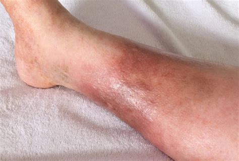 Leg Skin Discoloration Not A Dermatology Issue Precision Vascular