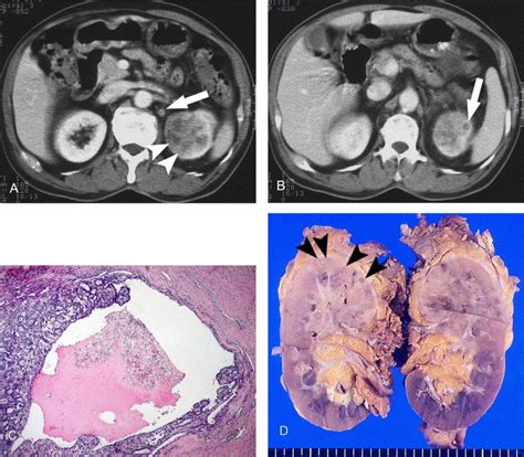 Collecting Duct Carcinoma Of The Kidney Ct And Pathologic Correlation