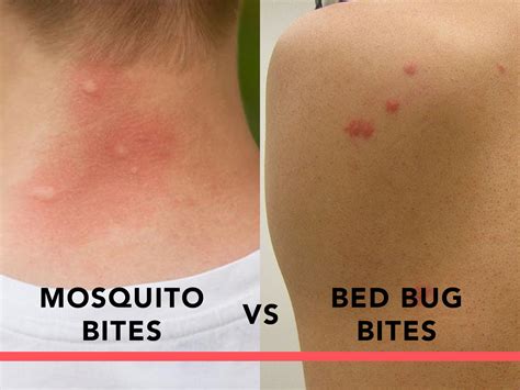 Can Bed Bug Bites Look Like Whiteheads Whatodi