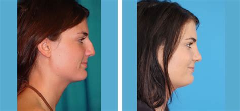 Before Your Rhinoplasty Denver Septoplasty Pre Surgery Tests