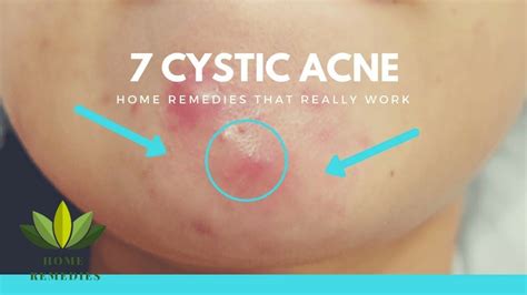 7 Cystic Acne Natural Remedies That Really Work Youtube