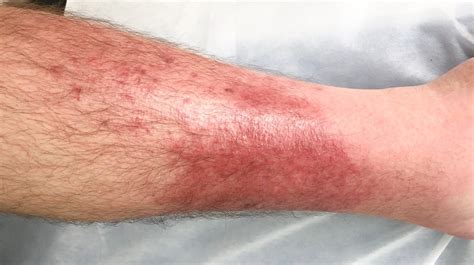 Rash And Skin That Feels Hot To The Touch Causes And Photos