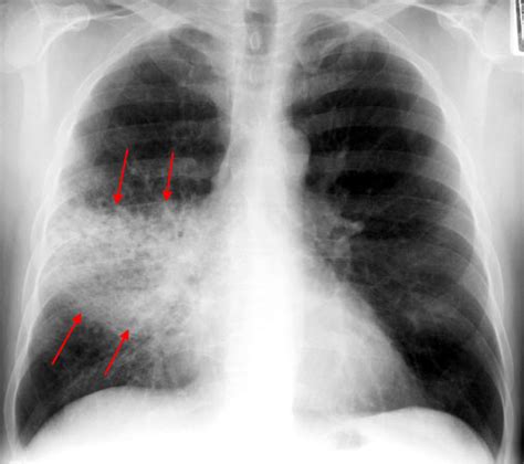 How To Read A Chest Xray Ii Pneumonia Medchrome