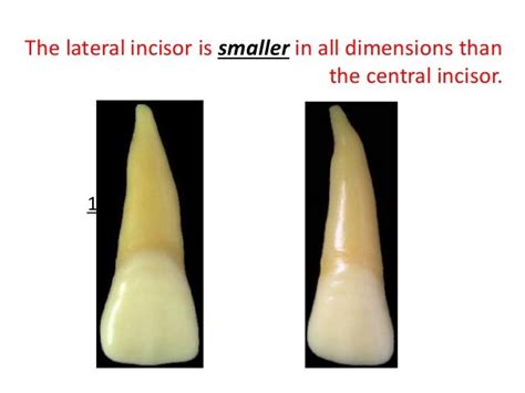 Upper Lateral Incisor