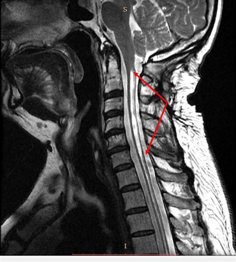 Sagittal T2 Weighted Magnetic Resonance Imaging Mri Of The Spine