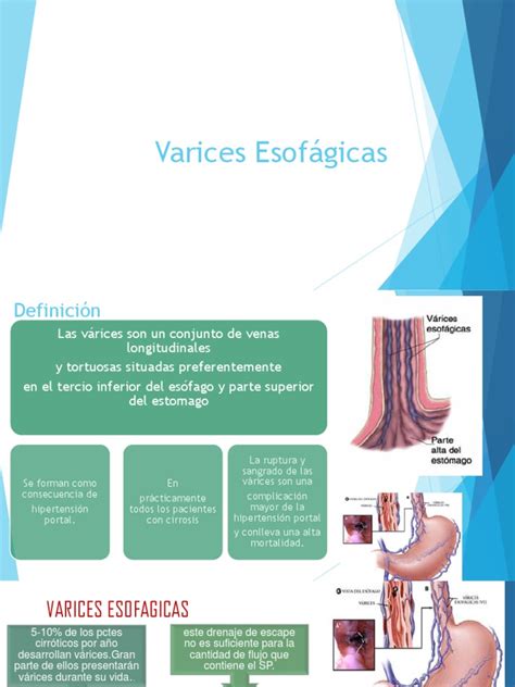 Varices Esofágicas Enfermedades Vasculares Medicina Clinica