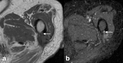 Figure 9 From MRI Findings In Gluteus Maximus Tendinopathy The