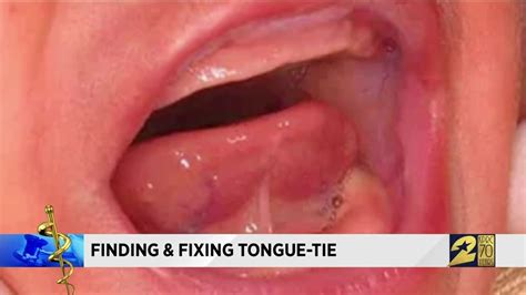Finding And Fixing Tongue Tie Youtube