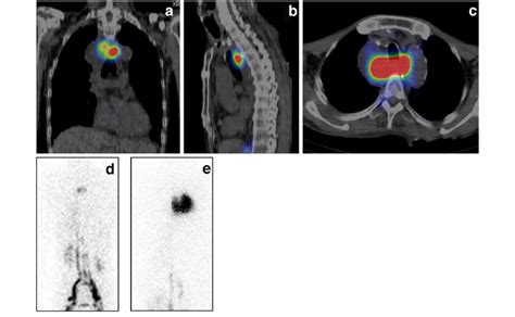 Lymphoscintigraphy With 99m Tc Hsa D Before The Reoperation A Coronal