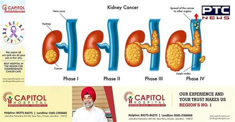 What are the symptoms of kidney cancer? Understanding Kidney Cancer - Common Types and Symptoms