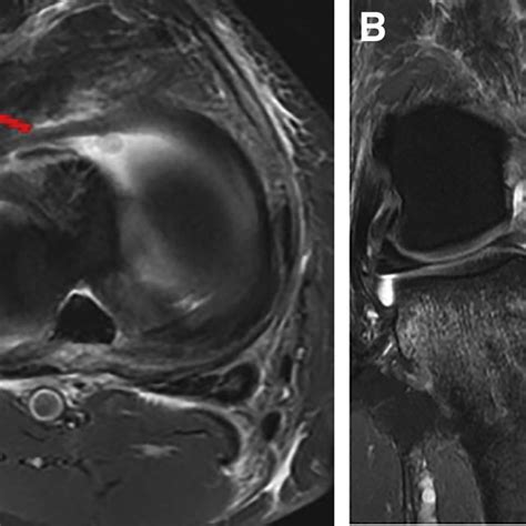 A Axial Mri Image Of A Right Knee Demonstrating A Radial My Xxx Hot Girl