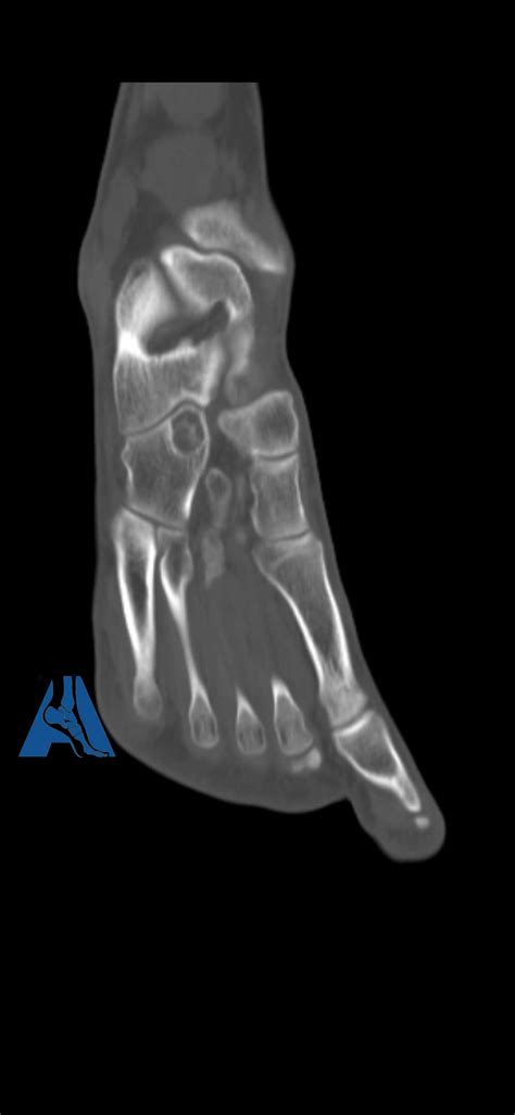 Bone Tumor Adams Foot And Ankle Surgery