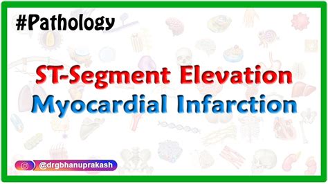 Complications Of St Segment Elevation Myocardial Infarction Stemi