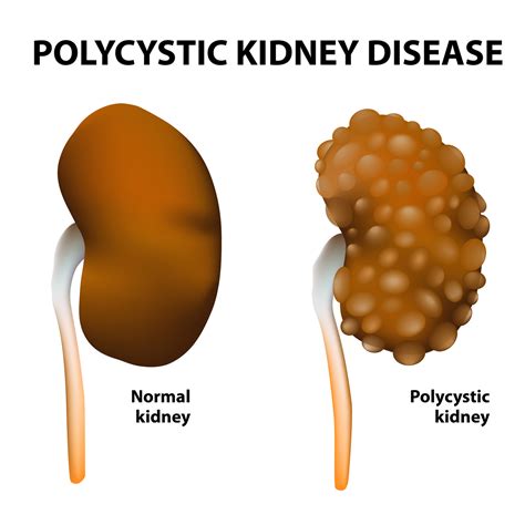 Treatment For Kidney Disease Can I Die Of Polycystic Kidney Diseasepkd